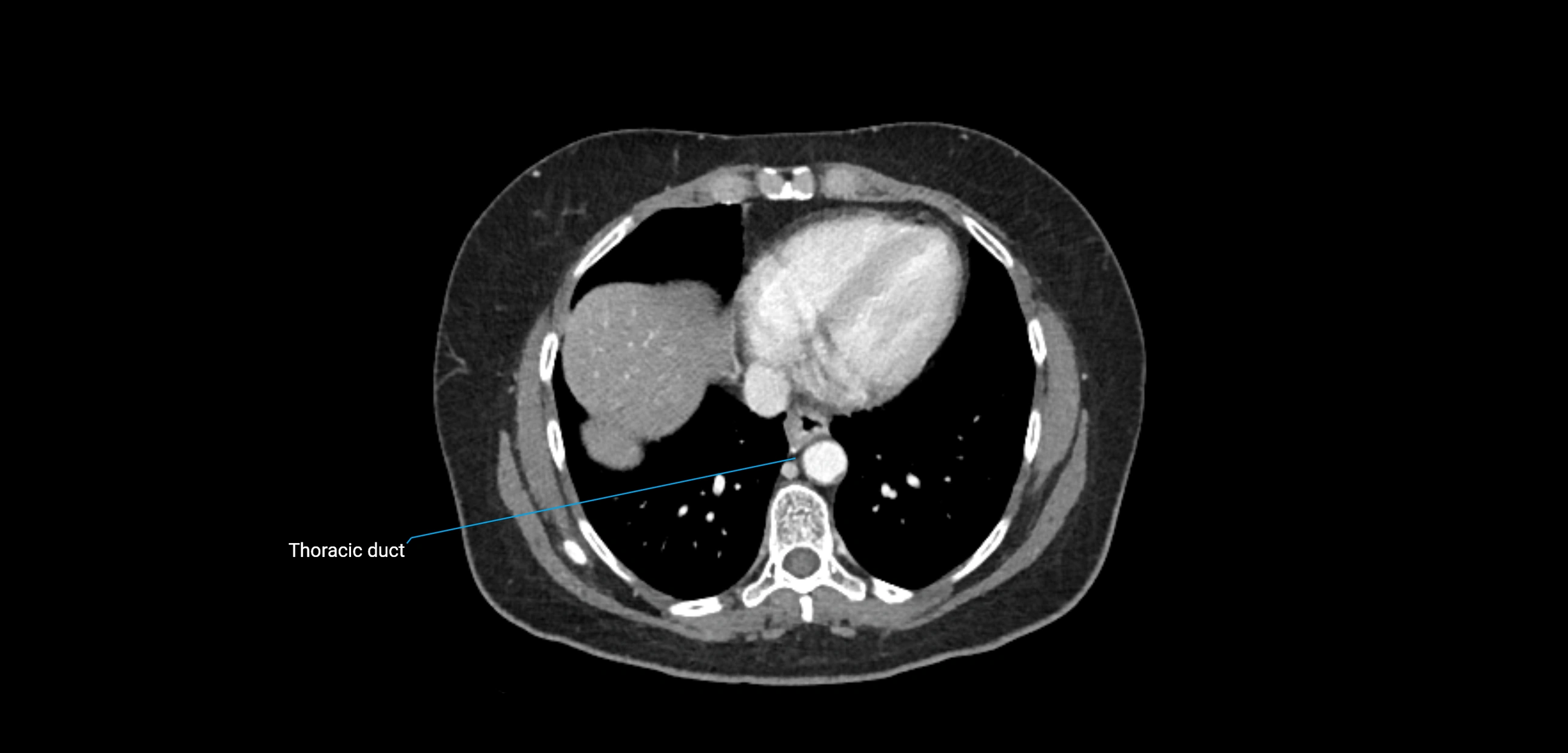 CT ct abdominal lymph nodes  axial cross sectional anatomy  enchanced radiology image -img-00002-00057.webp